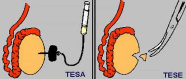 vto-sa-tesa-postupkom